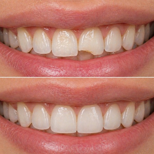 Restauración Dental