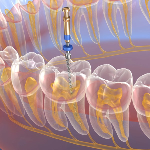 Endodoncia
