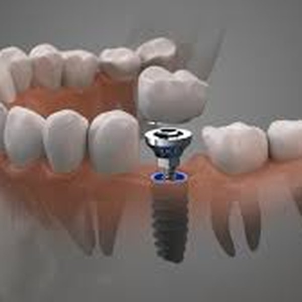Implantes Dentales