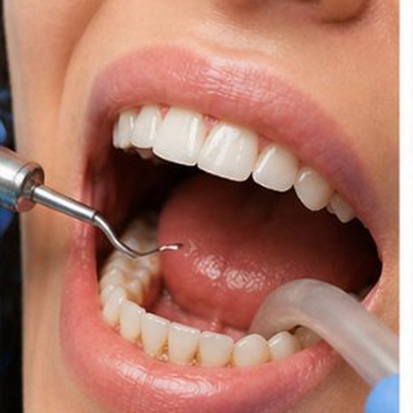 Limpieza Dental